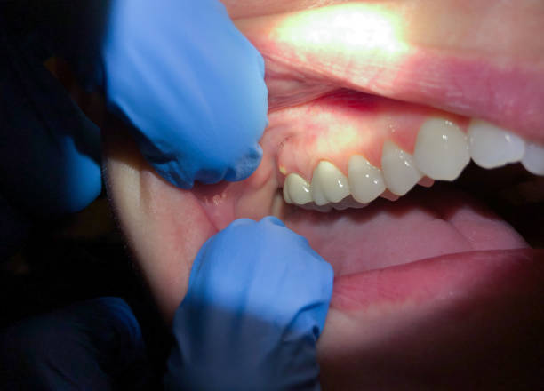 Best Emergency Wisdom Teeth Removal in Burlington, KY